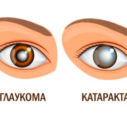 глаукома катаракта